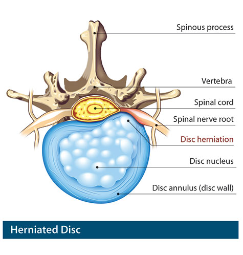 How do you treat a herniated disc?